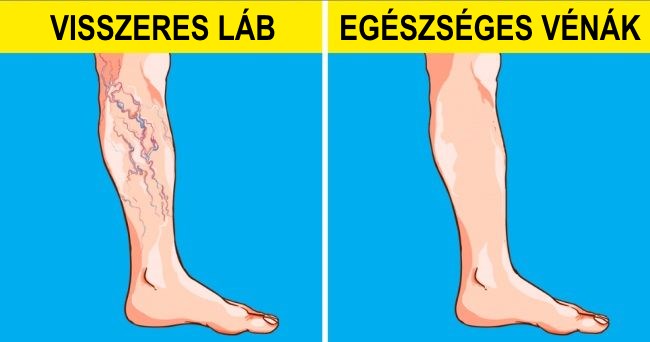 a visszeres lábak bekötésének módjai