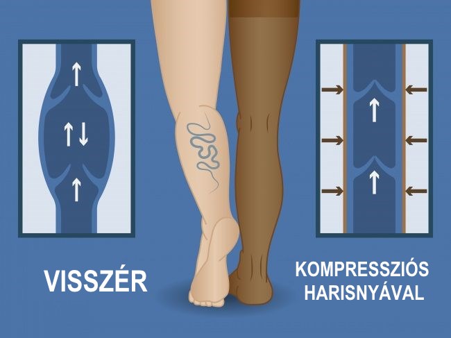 Visszeres láb: amikor nem elég a kompressziós harisnya - Harisnya visszér megelőzése vásárolni