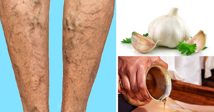 természetes olajok visszér ellen hatékony módszerek a varikózis kezelésére a lábakon
