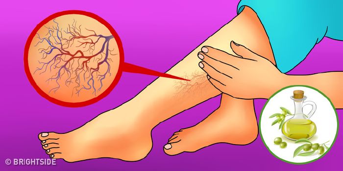 a visszér agyagkék kezelése hogyan lehet enni visszérrel a lábakon