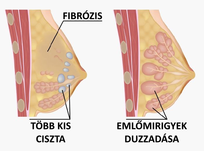 fibrocisztás mell és fogyás)