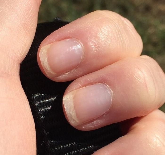 mit köröm gombás néz ujjain kezelés gombák nail leghatékonyabb készítmények