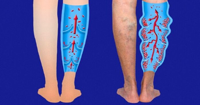 Gyakorlat a lábak számára a visszér ellen - Visszér fájdalom csillapítása – 4 hatékony módszer!