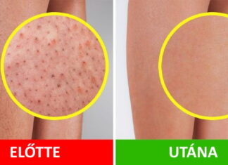 7 egyszerű módszer, hogy búcsút mondhass az eperbőrnek