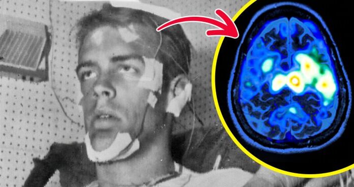 Hosszú távú hatásokkal nézett szembe a férfi, aki egy kísérlet kedvéért 264 órán át nem aludt